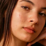 comment enlever les boutons sur le visage — Comment enlever les boutons sur le visage