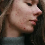 comment ne plus avoir de boutons — Comment ne plus avoir de boutons : bouton dans le dos stress