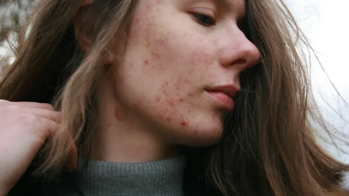 comment ne plus avoir de boutons — Comment ne plus avoir de boutons : bouton dans le dos stress